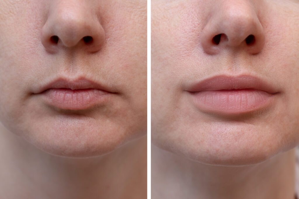 A woman 's lips before and after lip augmentation.