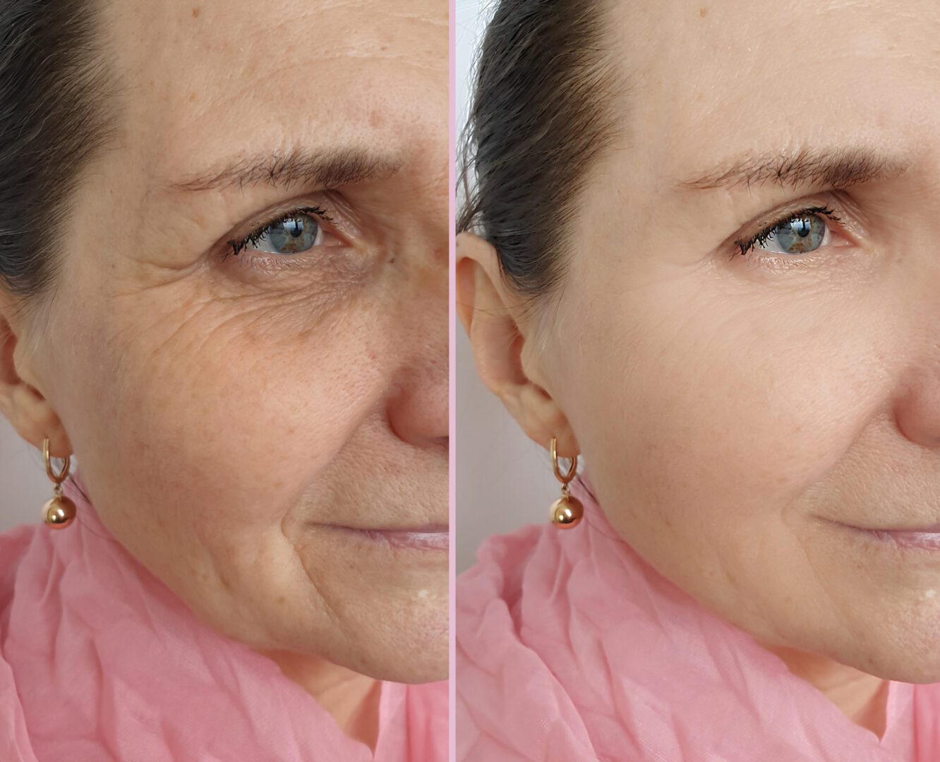 A woman with wrinkles on her face and before and after